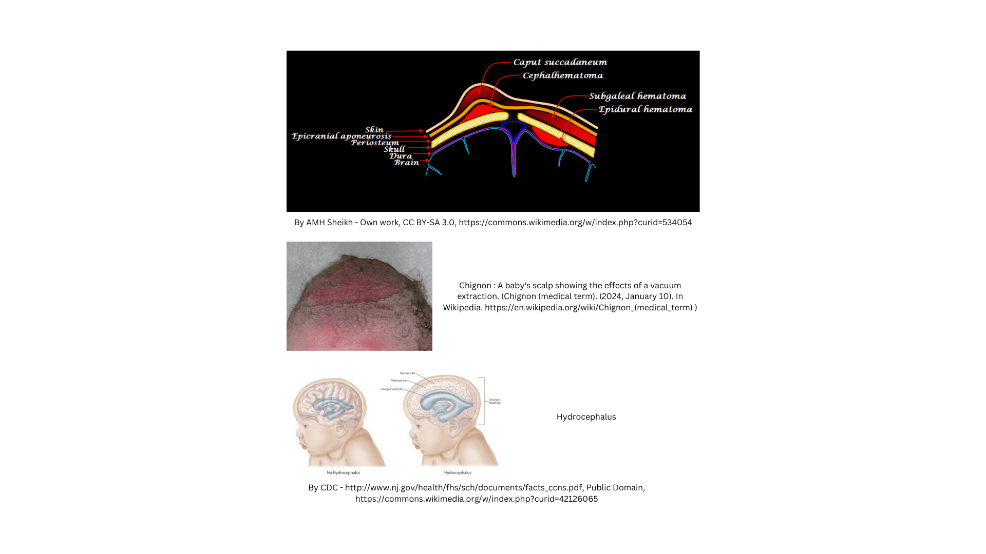 Cranial swellings in infants ; Differentials