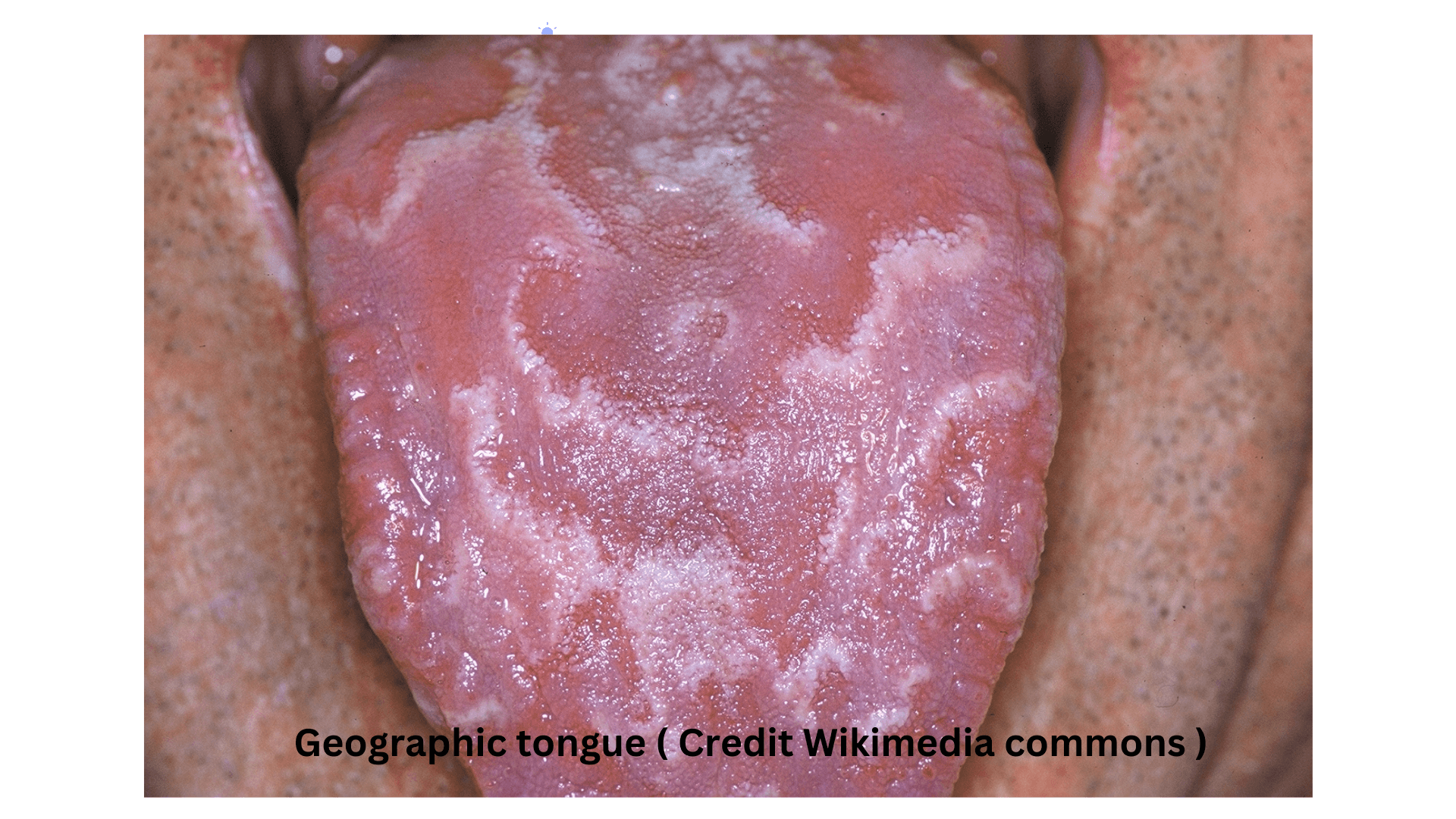 Geographic tongue ( Benign migratory glossitis )