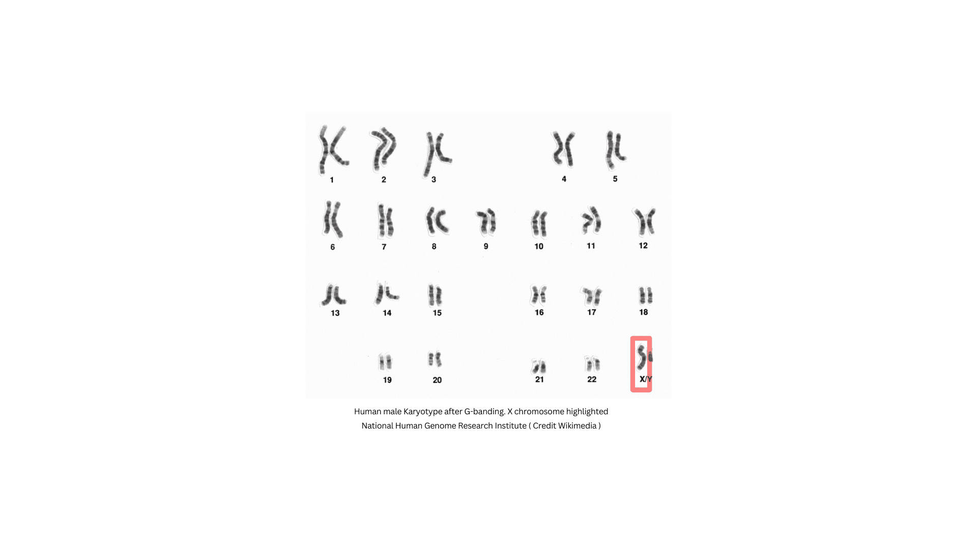 X-linked recessive disorders